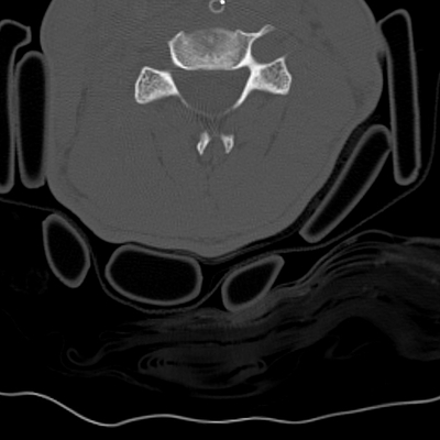 traumatisme cranien, oedème pulmonaire, lacération du rein rachis cervical axial os