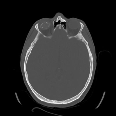 Thoracic Injuries, Spinal Injuries L5, Traumatic disc herniation Head CT, Axial plane, Bone window