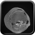 Tibial encondroma  MRI Lower limb Axial