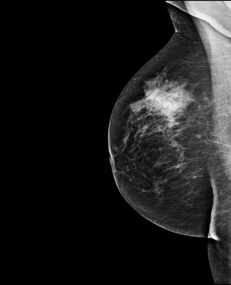Asymétrie mammaire avec petit nodule dont l’aspect est en faveur d’un fibroadénome au sein d'un tissu glandulaire plus dense à droite. 3-RMLO