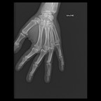 enchondrome Radiographie Membre supérieur enchondrome Radiographie Membre supérieur
