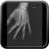 enchondrome  Radiographie Membre supérieur