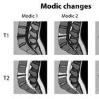 Modic changes on MRI modic-changes-degenerative-disk Modic changes on MRI modic-changes-degenerative-disk