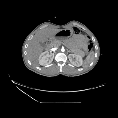 Cranioencephalic injuries, limb injuries, aspiration pneumonia Chest, Abdomen and Pelvis, Arterial phase, Axial plane