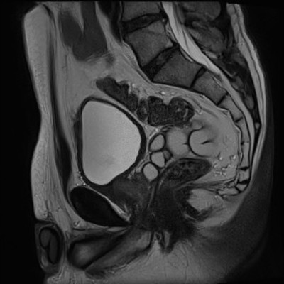Kyste de la vésicule séminale et agénésie rénale homolatérale IRM Pelvis Sagittal T2