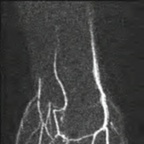 Hypothenar hammer syndrome TWIST COR RES TEMP=2.6s_SUB_MIP_COR Hypothenar hammer syndrome TWIST COR RES TEMP=2.6s_SUB_MIP_COR