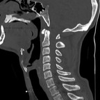Entorse grave du rachis cervical Sagittales fenêtre osseuse Entorse grave du rachis cervical Sagittales fenêtre osseuse