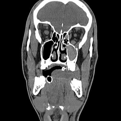 Cranioencephalic trauma, Facial fracture, Thoracic injuries, Pelvic fracture, Spleen and renal trauma Face CT, Coronal plane, Soft tissue window
