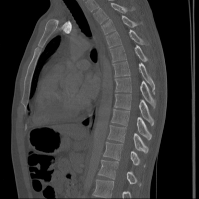 Thoracic Injuries, Spinal Injuries L5, Traumatic disc herniation Dorsal spine, Sagittal plane, Bone window