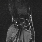 Ténosynovite de De Quervain IRM poignet Coronal DP SPAIR Ténosynovite de De Quervain IRM poignet Coronal DP SPAIR