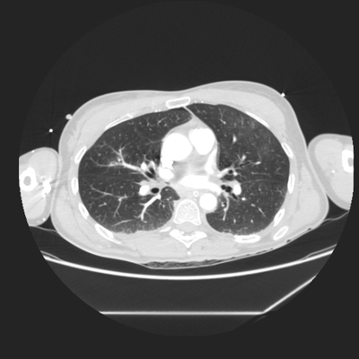 Craniocerebral trauma, Carotid artery injury with dissection, traumatic perforation of GI tract, pulmonary artery injury, Chance fracture Chest CT, Lung window, Axial plane