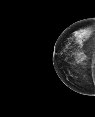 Asymétrie mammaire avec petit nodule dont l’aspect est en faveur d’un fibroadénome au sein d'un tissu glandulaire plus dense à droite. 1-Rcc