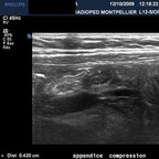 Appendicite aigüe médicale (catarrhale) ECHO TD Appendicite aigüe médicale (catarrhale) ECHO TD