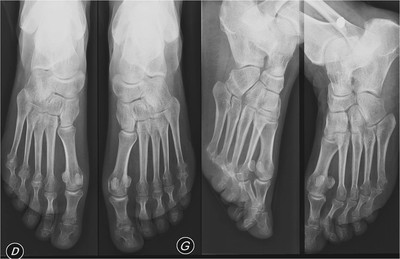 Polyarthrite rhumatoïde  Radiographie Membre inférieur