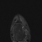 Séquelles post traumatiques du ligament collatéral latéral IRM axial DP fat sat Séquelles post traumatiques du ligament collatéral latéral IRM axial DP fat sat