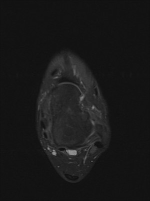 Séquelles post traumatiques du ligament collatéral latéral IRM axial DP fat sat