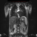 Dermatomyosite avec atteinte musculaire étendue IRM STIR coronal Dermatomyosite avec atteinte musculaire étendue IRM STIR coronal