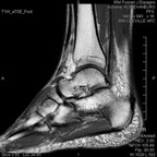 Rupture partielle du tendon calcanéen IRM Rupture partielle du tendon calcanéen IRM