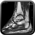 Rupture partielle du tendon calcanéen IRM