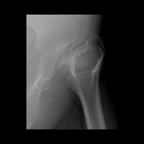 Corps étrangers intra-articulaires sur dysplasie de hanche et ostéonécrose Arthrographie Corps étrangers intra-articulaires sur dysplasie de hanche et ostéonécrose Arthrographie