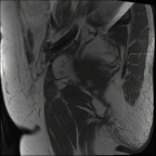 Ostéonécrose aseptique bilatérale des têtes fémorales IRM Sagittal T1 TSE Ostéonécrose aseptique bilatérale des têtes fémorales IRM Sagittal T1 TSE