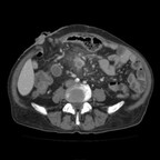 Adénocarcinome colique du colon transverse TDM Abdomen Axial Temps veineux Adénocarcinome colique du colon transverse TDM Abdomen Axial Temps veineux