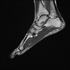 Tendinopathie aiguë achiléenne droite inflammatoire et myoaponévrosite plantaire superficielle T1 Sagittal Tendinopathie aiguë achiléenne droite inflammatoire et myoaponévrosite plantaire superficielle T1 Sagittal