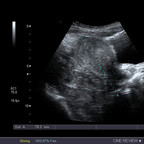 Rupture de kyste hémorragique avec hémopéritoine et fuite active Echographie Pelvis Rupture de kyste hémorragique avec hémopéritoine et fuite active Echographie Pelvis