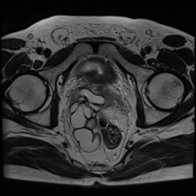Kyste de la vésicule séminale et agénésie rénale homolatérale IRM Pelvis Axial T2