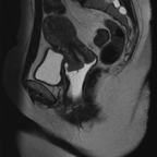 Cancer du col avec extension aux paramètres Sagittal T2 Cancer du col avec extension aux paramètres Sagittal T2