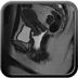 Cancer du col avec extension aux paramètres Sagittal T2