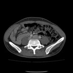 Mésentère commun. TDM Abdomen Axial Mésentère commun. TDM Abdomen Axial