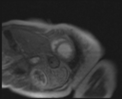 Syndrome de Tako-Tsubo - Myocardite adrénergique Perfusion de premier passage - Petit axe