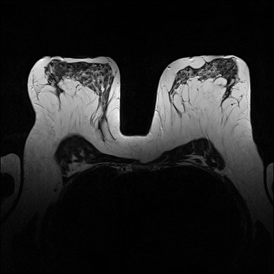 Doute sur une distorsion architecturale du QSE droit, correspondant à des superpositions en tomosynthèse. T2