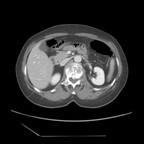 Carcinose pleurale d'un cancer primitif mammaire TDM thorax abdomen pelvis axial veineux Carcinose pleurale d'un cancer primitif mammaire TDM thorax abdomen pelvis axial veineux