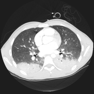 traumatisme cranien, oedème pulmonaire, lacération du rein thorax poumon ax