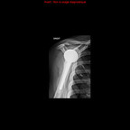 Prothèse de l'épaule Radiographie Membre supérieur Prothèse de l'épaule Radiographie Membre supérieur