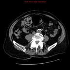 Corps étranger intrasigmoïdien (bouteille) TDM Abdomen Axial Fenêtre Tissus mous Corps étranger intrasigmoïdien (bouteille) TDM Abdomen Axial Fenêtre Tissus mous