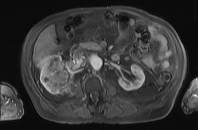 Adénocarcinome rénal droit avec envahissement de la veine rénale et de la VCI Arteriel post Gado