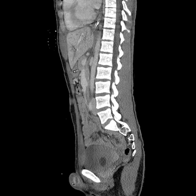 traumatisme cranien, oedème pulmonaire, lacération du rein abdomen portal sagittal
