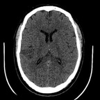 Infarctus du myocarde compliqué de thrombus intra-VG et d'AVC sylvien droit embolique sans injection Infarctus du myocarde compliqué de thrombus intra-VG et d'AVC sylvien droit embolique sans injection