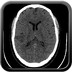 Infarctus du myocarde compliqué de thrombus intra-VG et d'AVC sylvien droit embolique sans injection