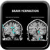 Anatomy of the brain cerebral-brain-herniation
