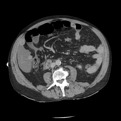Hepatic fracture, Active hemorrhage Abdomen CT, Delayed phase, Axial plane