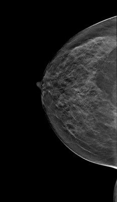 Carcinome canalaire in situ supéro-médian droit RCC Tomosynthèse