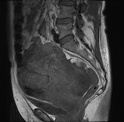 Cystadénocarcinome ovarien séro-papillaire moyennement différencié Stade IIIb Sagittal T1
