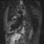 Amylose cardiaque de type AL T2-DB-SPIR Amylose cardiaque de type AL T2-DB-SPIR