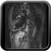 Amylose cardiaque de type AL T2-DB-SPIR