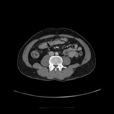 fracture du condyle occipital, traumatisme thoracique, fracture et contusion hépatique, hématome de la surrénale abdomen portal axial
