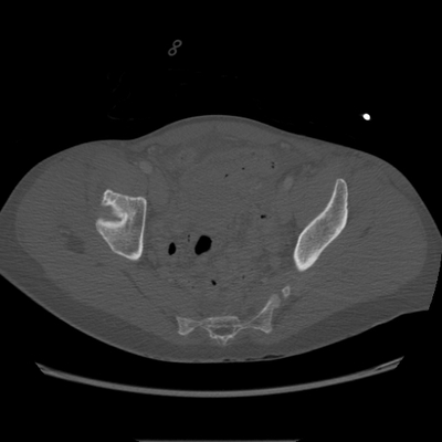Traumatic perforation of small intestine, fracture of lumbar vertebra Pelvic CT, Axial plane, Bone window